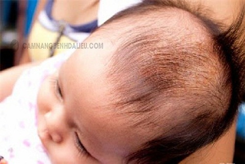 trị nấm da đầu cho trẻ