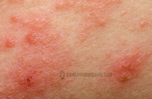 Eczema có thể gây bất lực
