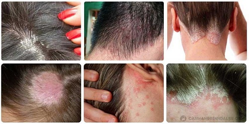 Nấm da đầu là bệnh lý da liễu gây ra nhiều triệu chứng ngứa ngáy, khó chịu, ảnh hưởng cả về sức khỏe lẫn thẩm mỹ