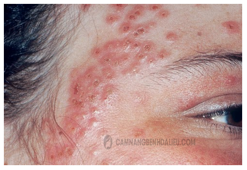 Trị Eczema bằng thuốc Amoxicillin