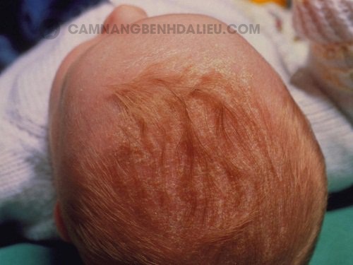 Dấu hiệu nhận biết viêm da đầu ở trẻ sơ sinh