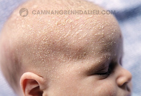 Nguyên nhân gây viêm da đầu ở trẻ sơ sinh