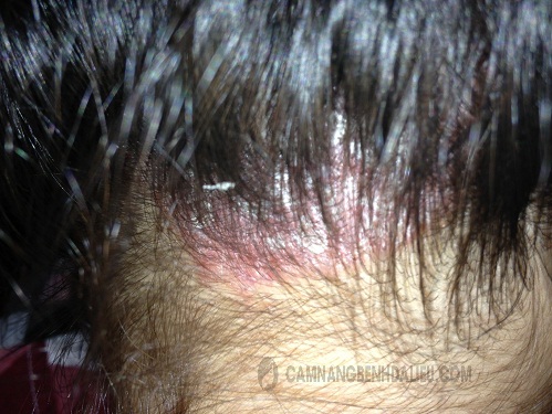 3 cách chăm sóc cho da đầu khỏe mạnh
