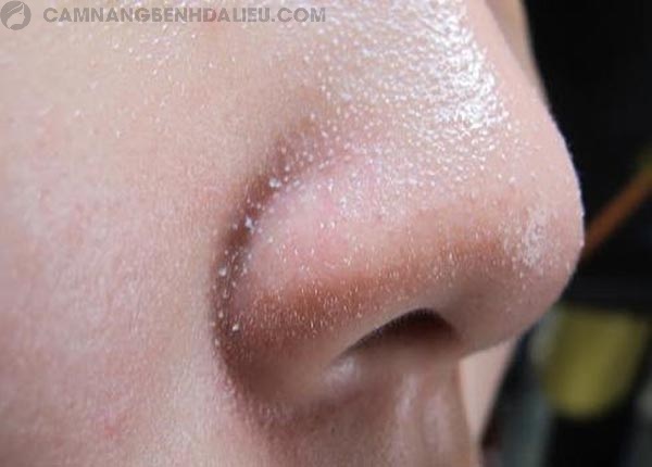 Mũi là vùng da mụn cám tập trung nhiều nhất