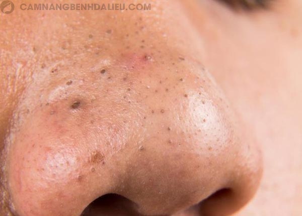 Mũi là vùng tiết nhiều bã nhờn nhất trên khuôn mặt nên rất dễ bị mụn đầu đen