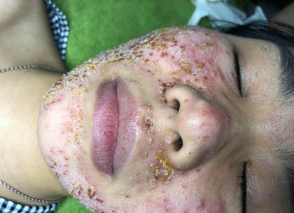 Làn da của Nguyễn Thị Hải Yến sau khi dùng Ngọc Sâm