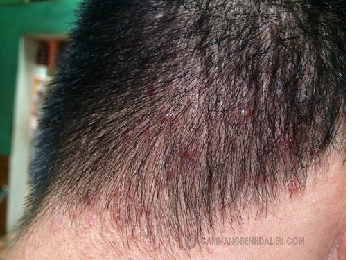 bệnh nấm da đầu