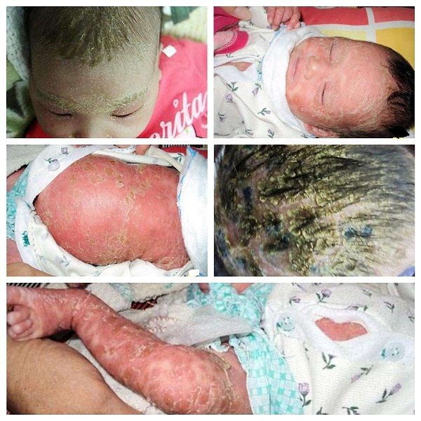 Một số hình ảnh viêm da dầu ở trẻ em