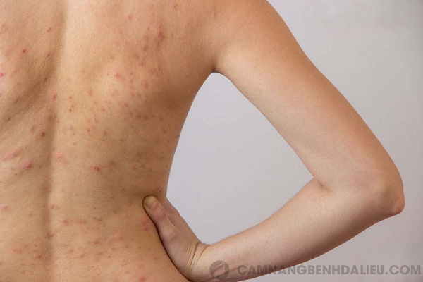 Những nốt mẩn đỏ xuất hiện trên vùng da ở lưng