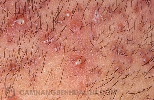 Triệu chứng viêm nang lông vùng kín