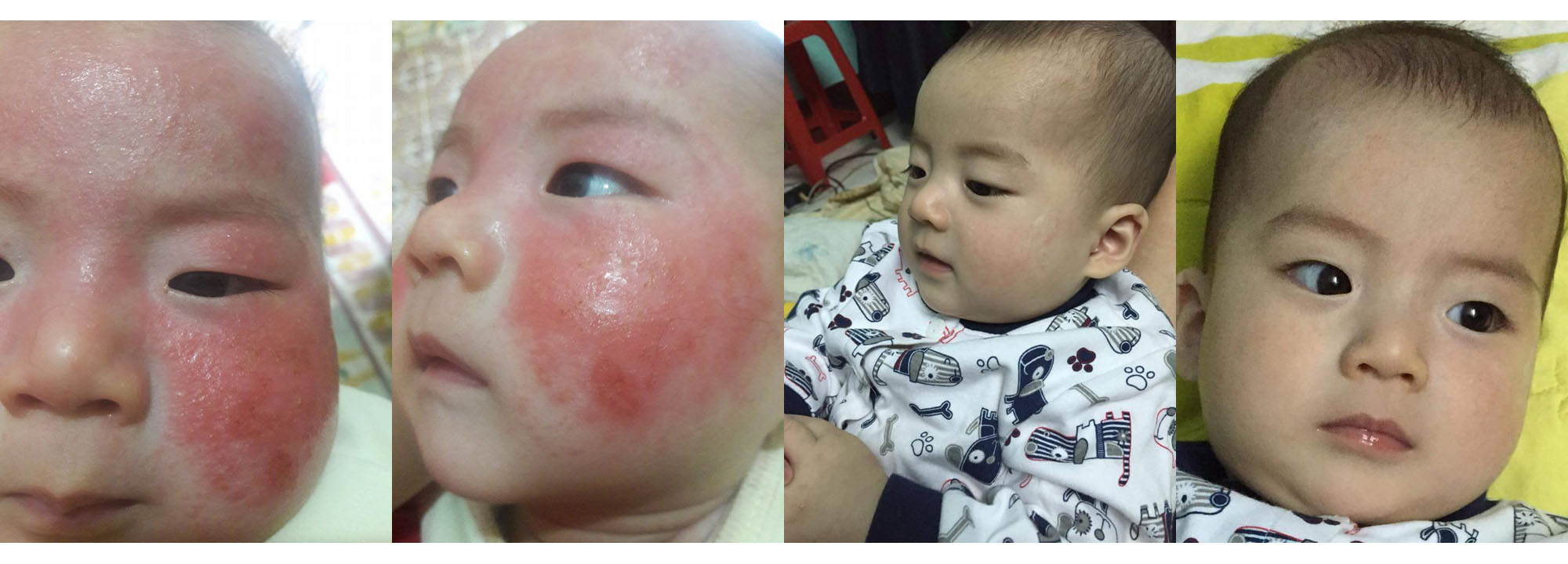 Hình ảnh bé Sơn Tùng trước và sau khi điều trị bệnh viêm da cơ địa bằng thuốc nam
